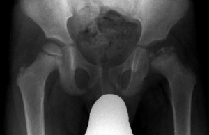צילום רנטגן של מפרק ירך הלוקה בפרטס