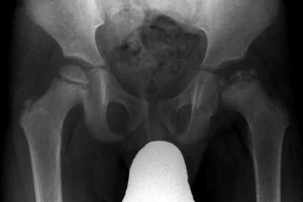 צילום רנטגן של מפרק ירך הלוקה בפרטס